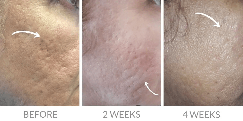Voor en na acne litteken behandeling